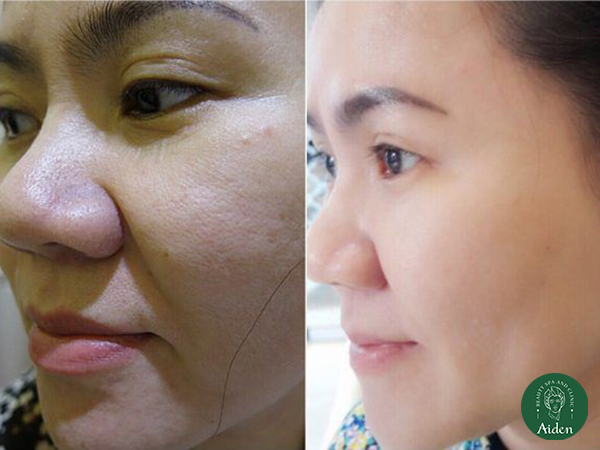 Phi kim vi điểm có tác dụng gì