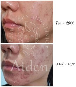 có nên phi kim trị mụn không