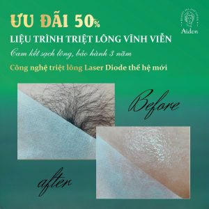Triệt lông vùng kín Triệt lông vùng kín