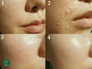 Cách chăm sóc da sau khi vi kim tảo biển