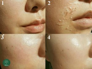 lăn kim bao lâu thì được rửa mặt
