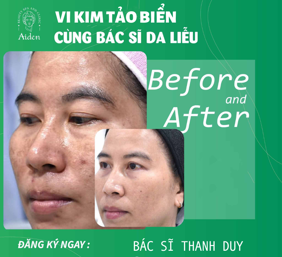 liệu trình vi kim