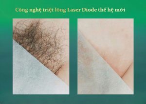 Triệt lông bikini vĩnh viễn giá bao nhiêu Triệt lông bikini vĩnh viễn giá bao nhiêu