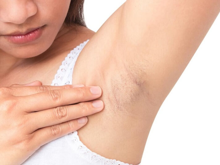 Triệt lông nách vĩnh viễn giá bao nhiêu