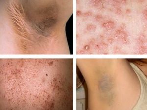 Tác hại khi wax lông nách bằng đường và chanh Tác hại khi wax lông nách bằng đường và chanh