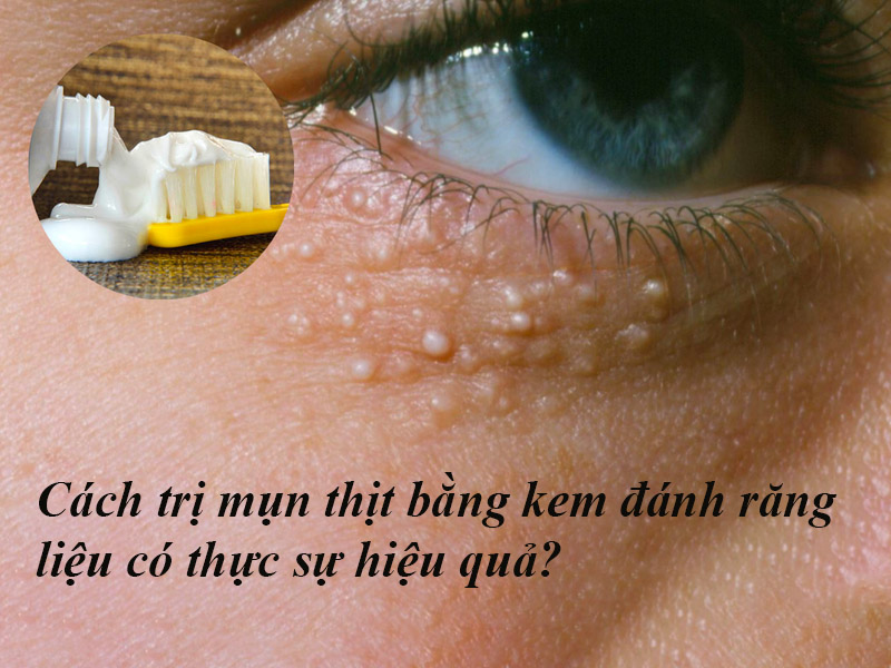 Cách trị mụn thịt bằng kem đánh răng