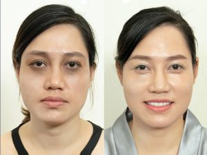 Cách trị thâm quầng mắt bằng muối - 1