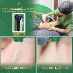 Triệt lông nách vĩnh viễn Triệt lông nách vĩnh viễn