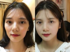 Cấy HA collagen làm đầy Cấy HA collagen làm đầy