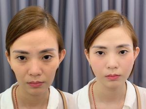Cấy HA collagen làm đầy má Cấy HA collagen làm đầy má