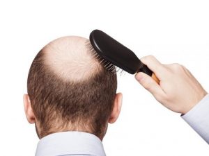 Hói đầu tuổi 20