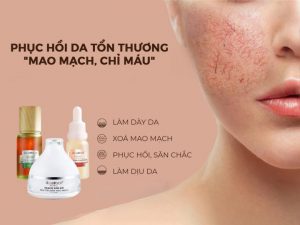 Kem trị da mặt mỏng nổi gân máu Kem trị da mặt mỏng nổi gân máu