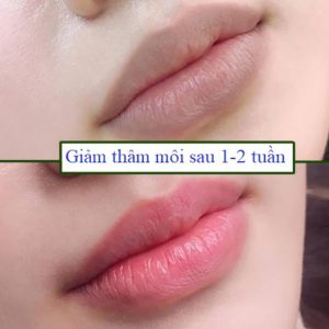 Khử thâm môi uy tín