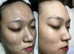 Liệu trình điều trị thâm mụn Liệu trình điều trị thâm mụn