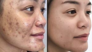 Trị thâm mụn Trị thâm mụn