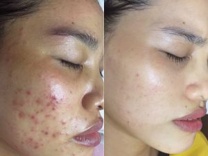 Liệu trình trị thâm mụn bao nhiêu tiền?