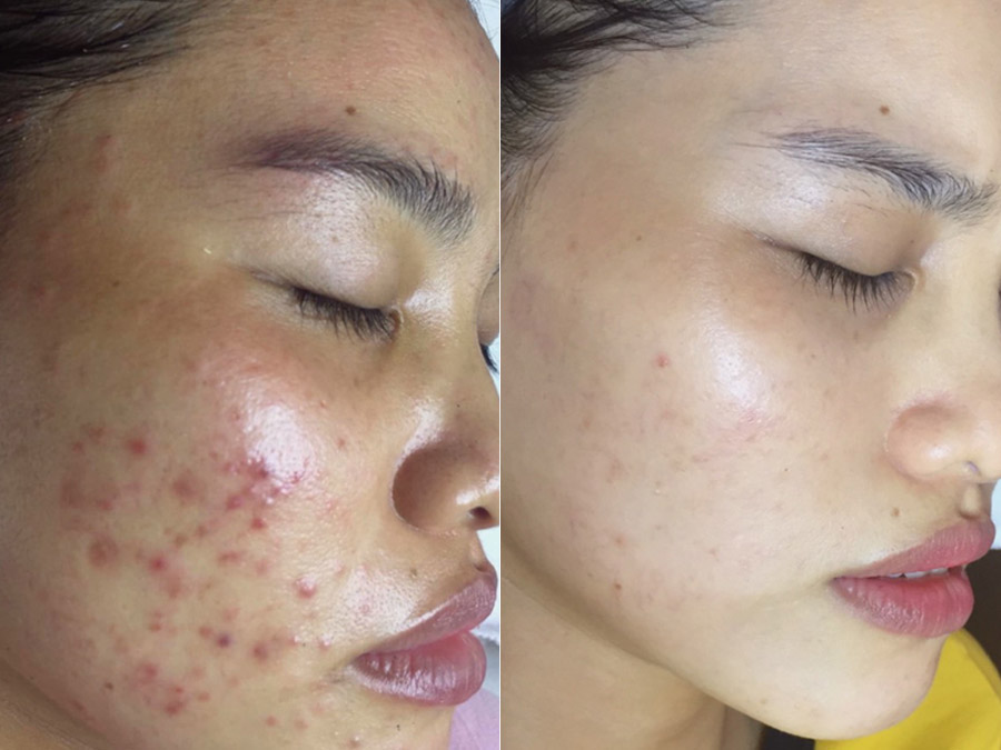 Liệu trình trị thâm mụn bao nhiêu tiền?
