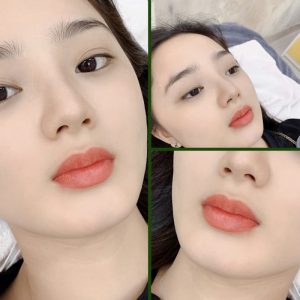Phun hồng môi collagen