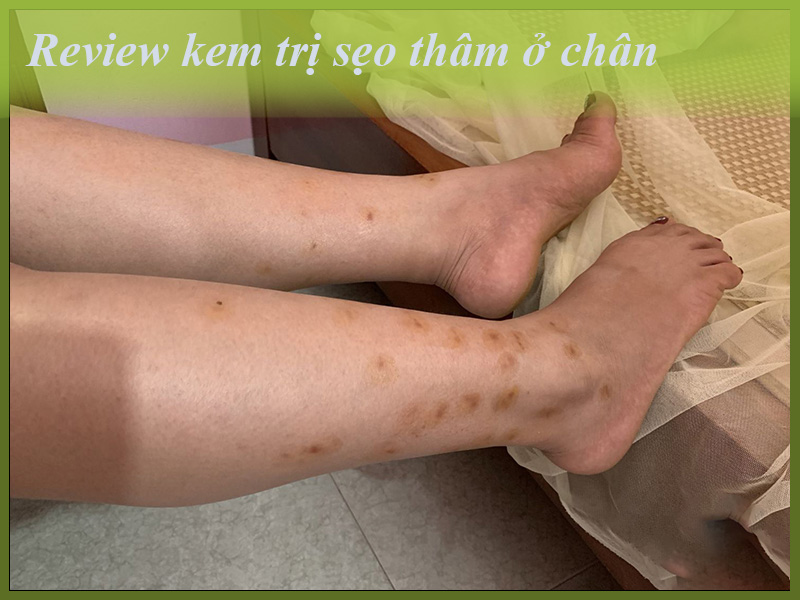Review kem trị sẹo thâm ở chân