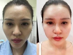 Tiêm HA collagen làm đầy Tiêm HA collagen làm đầy