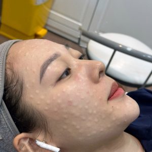 Tiêm Meso trị nám giá bao nhiêu?