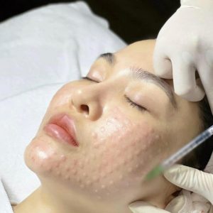 Tiêm Mesotherapy bao nhiêu tiền?