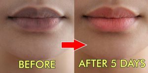 Trị thâm môi tại nhà