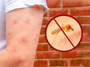 Trị vết muỗi đốt lâu ngày