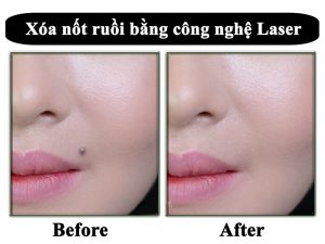 Cách tẩy nốt ruồi trong 1 ngày