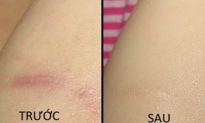 Cách trị sẹo bỏng thâm Cách trị sẹo bỏng thâm