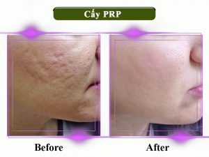 Cấy máu tự thân PRP giá bao nhiêu? Cấy máu tự thân PRP giá bao nhiêu?