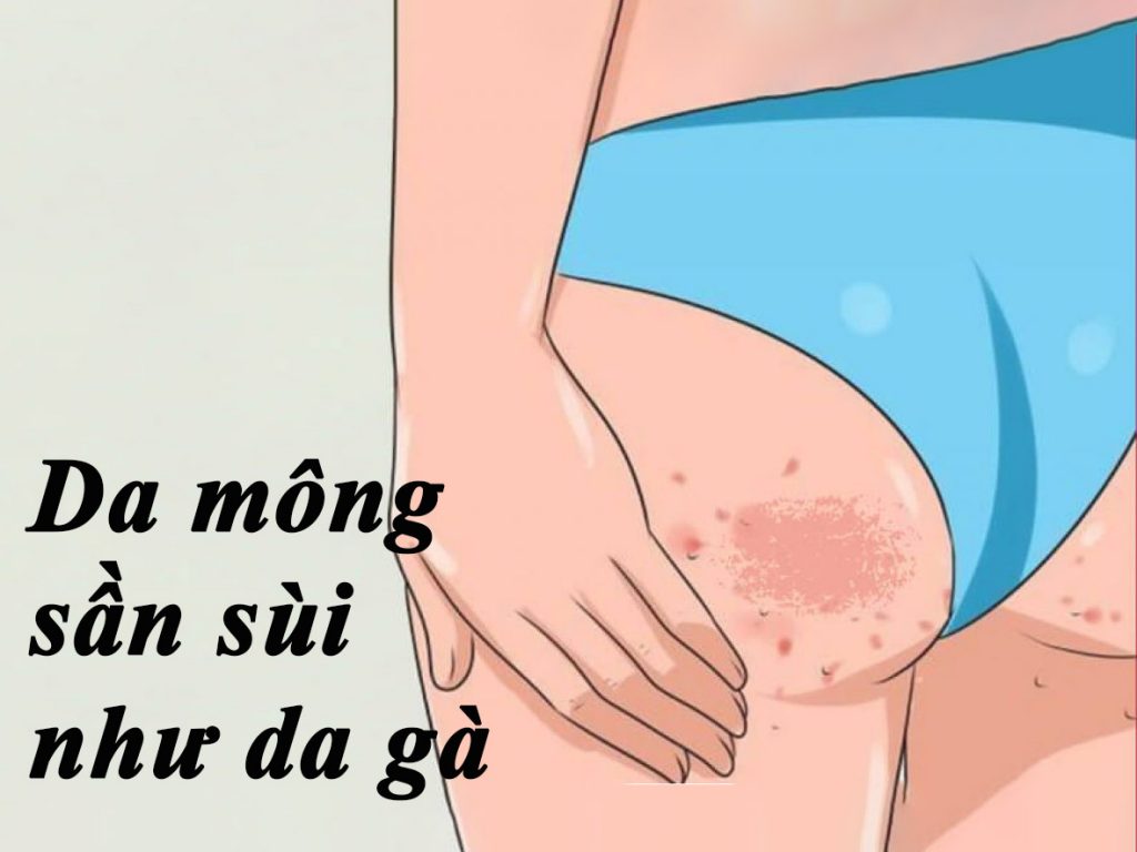 Da mông sần sùi như da gà