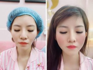 Địa chỉ tiêm Filler uy tín