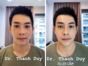 Filler được Bộ Y Tế cấp phép