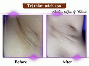 Làm trắng nách spa
