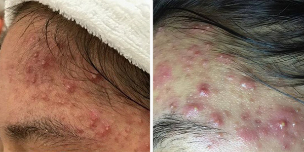 Mụn ở thái dương Mụn ở thái dương