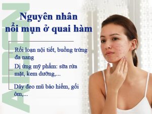 Nguyên nhân gây mụn ở quai hàm