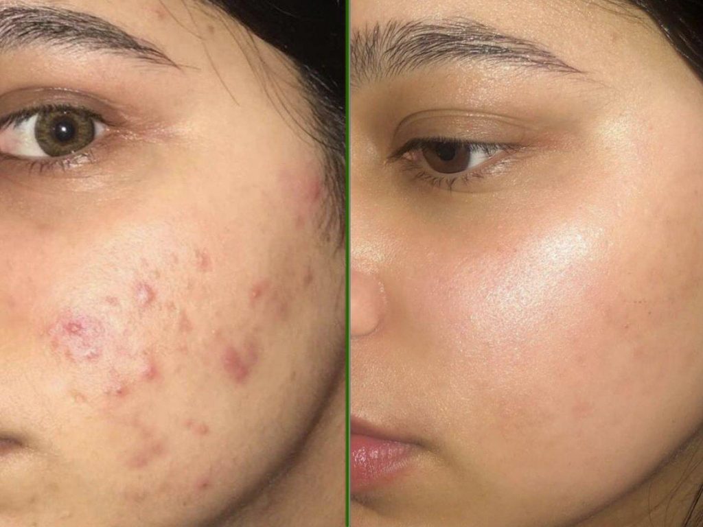 Peel da vi tảo retinol có tốt không?