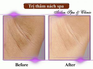Review spa trị thâm nách