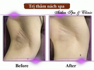 Spa trị thâm nách