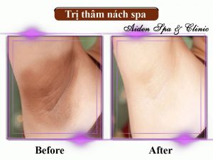 Spa trị thâm nách uy tín