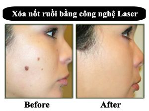 Tẩy nốt ruồi bằng đốt điện