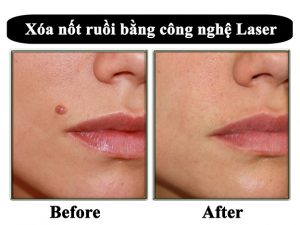 Tẩy nốt ruồi có đau không?
