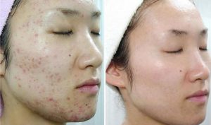 Trị mụn laser CO2 Trị mụn laser CO2