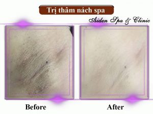 Trị thâm nách ở spa