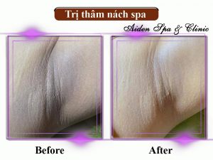 Trị thâm nách spa