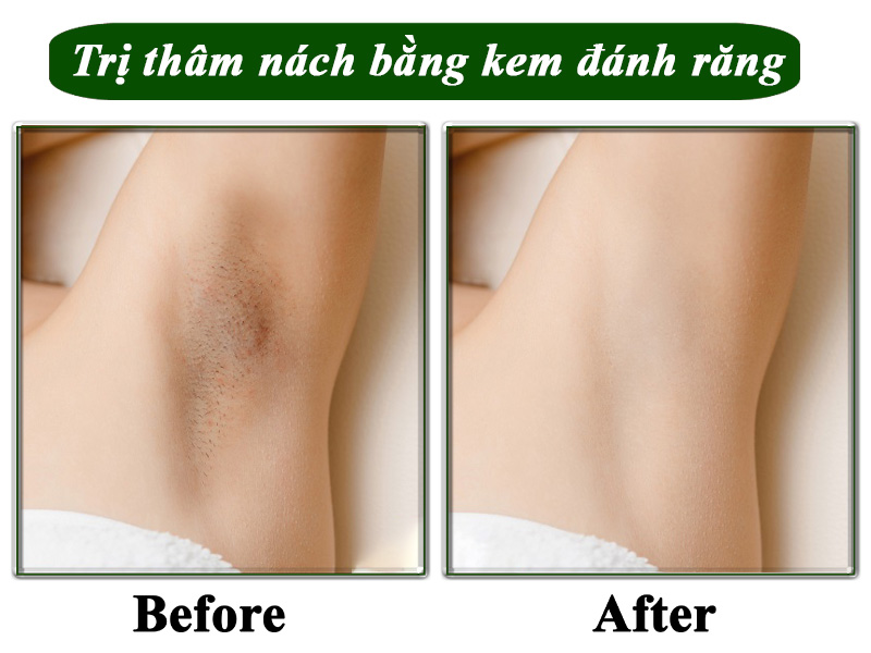 Trị thâm nách tại nhà bằng kem đánh răng