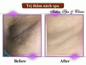 Trị thâm nách tại spa