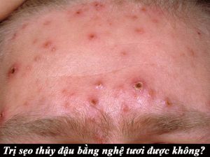 Vết thủy đậu