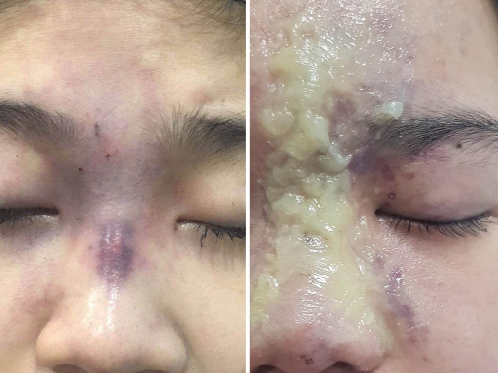 Tiêm mũi bị tràn